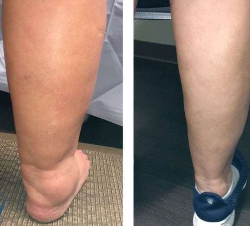 ChausseForm™ – Des jambes fines et une peau ferme en un seul geste !